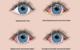 Вирусные заболевания глаза: классификация, симптомы, лечение
