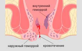 Жжение в заднем проходе у мужчин причины и лечение