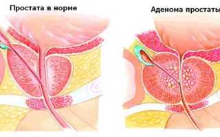 Ноющая боль в яичках у мужчин причины и лечение