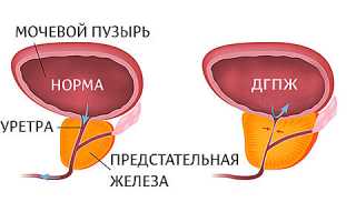 Доброкачественная гиперплазия предстательной железы