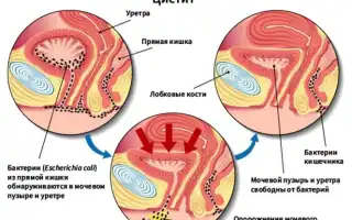 Выделения при женском цистите