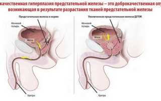 Дгпж 1 степени что это такое — Сайт о простатите