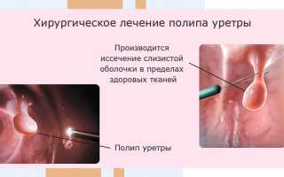 Симптомы и лечение полипа уретры у женщин
