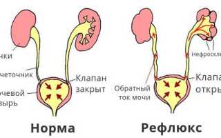 Рефлюкс мочи заброс в мочеточник и почки — Почки
