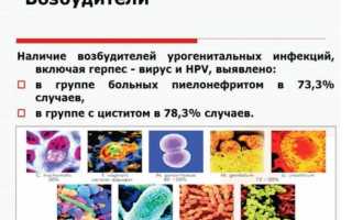 Острый геморрагический цистит: симптомы, причины, терапия
