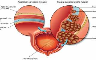 Опухоли почек и мочевого пузыря (рак мочевого пузыря лечение, опухоль мочевого пузыря операция)