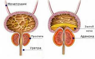 Урология в москве аденома