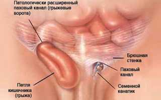Паховая грыжа и урология