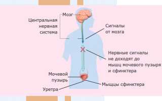 Нейрогенный мочевой пузырь у женщин и мужчин: лечение, симптомы