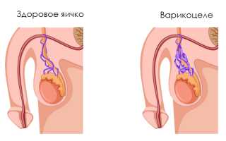 Варикоцеле у мужчин — «Московский Доктор»