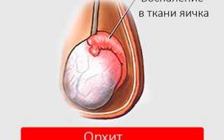 Боль в правом яичке: причины, симптомы, лечение