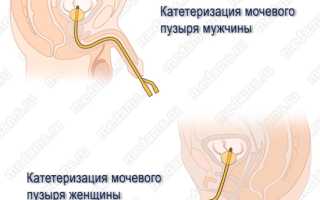 Уретральный катетер в урологии