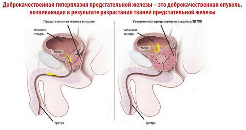 дгпж 1 степени урология